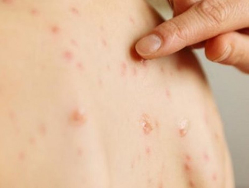 10-14 насны хүүхдүүдийн дунд улаанбурханы өвчлөл өндөр байна